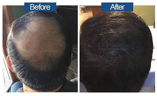 View Hair Transplant Surgery Before and After photos of successful results by Dr. Urvashi Chandra.