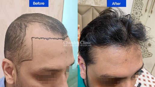 View Hair Transplant Surgery Before and After photos of successful results by Dr. Urvashi Chandra.