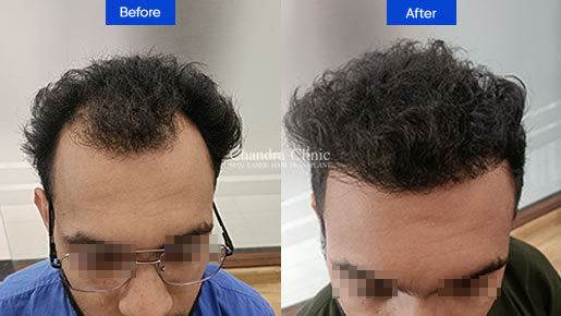 View Hair Transplant Surgery Before and After photos of successful results by Dr. Urvashi Chandra.